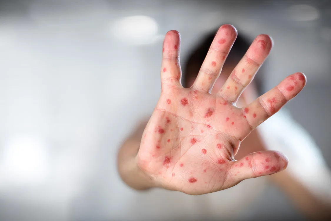 Sarampo: Estados Unidos registram primeiras mortes de 2026
