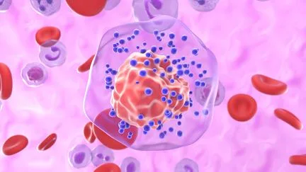 L'Institut Curie évoque de "vraies avancées" dans la lutte contre le cancer du sein triple négatif, parfois résistant aux traitements